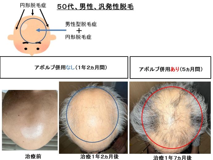 円形脱毛症　病院